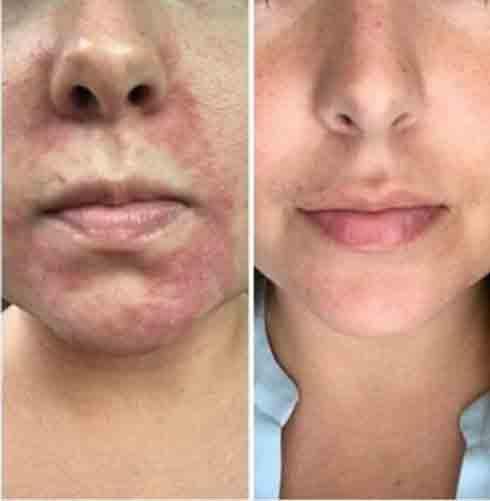 LED Therapy Face Mask | 7 Color Light Modes | Home Skin Care Device